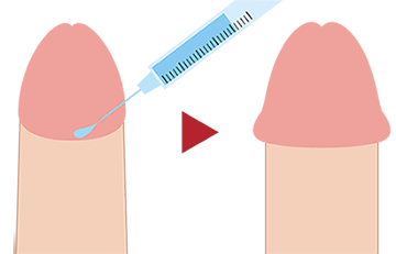 安全な薬剤をカリ首を中心に注入する亀頭増大術