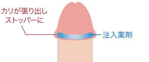 カリがストッパーになり包茎改善
