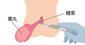 睾丸摘出手術：摘出