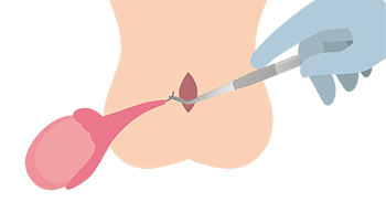 睾丸摘出手術：精索摘出